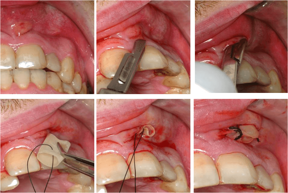 Incision et drainage d'un abces dentaire - procedure chirurgicale
