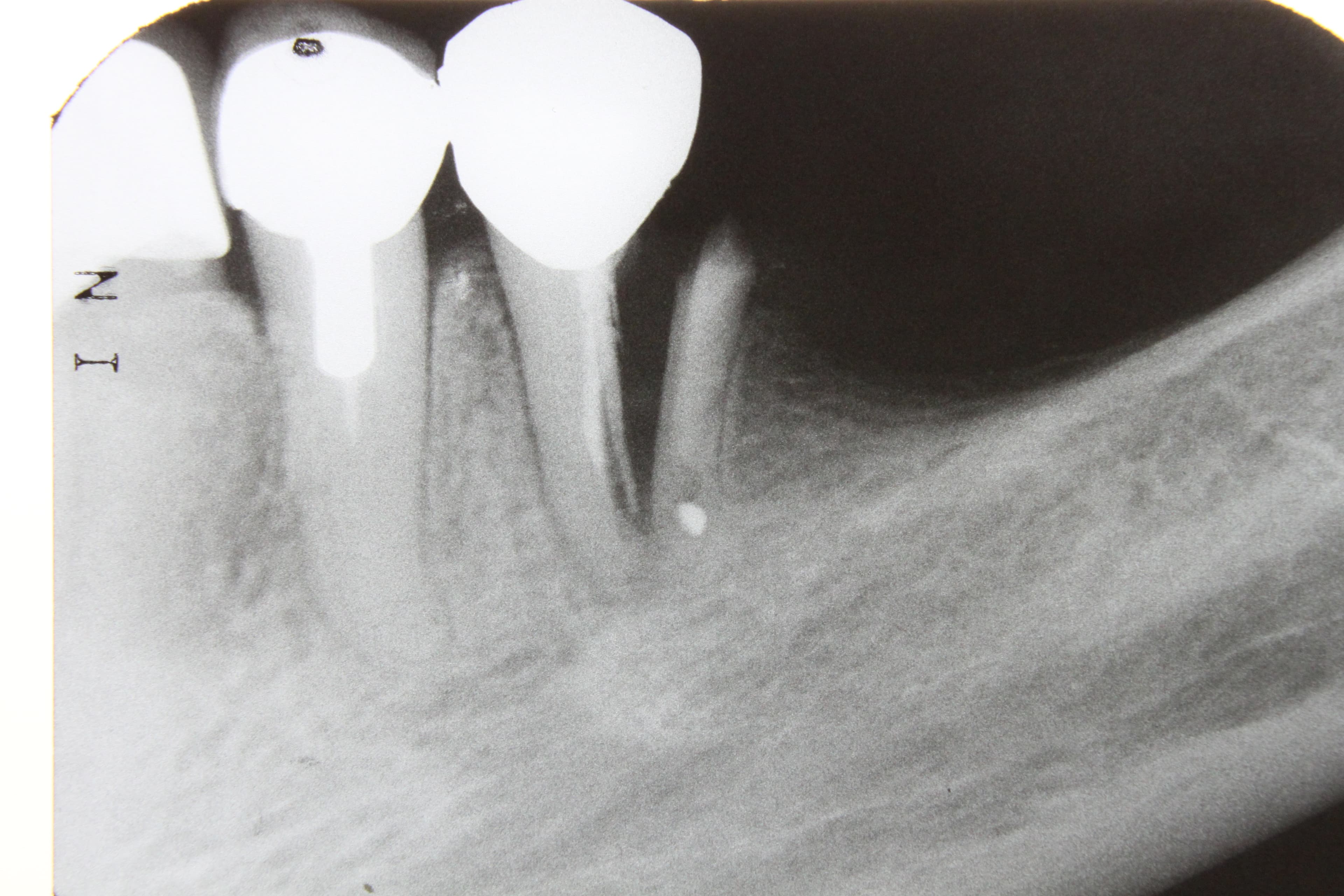Radiographie dentaire montrant une fracture et les structures internes de la dent