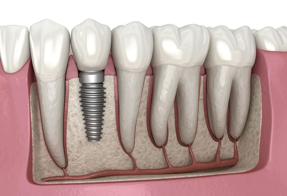 Illustration d'un implant dentaire et de sa structure