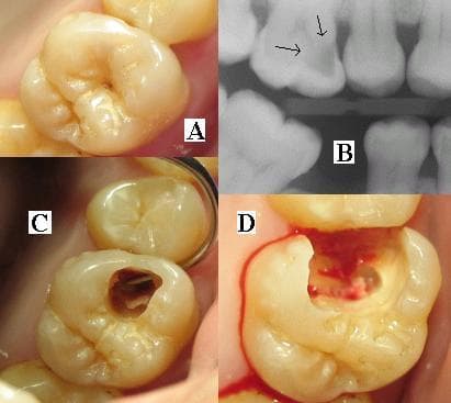 Radiographie dentaire montrant les differentes structures d'une dent