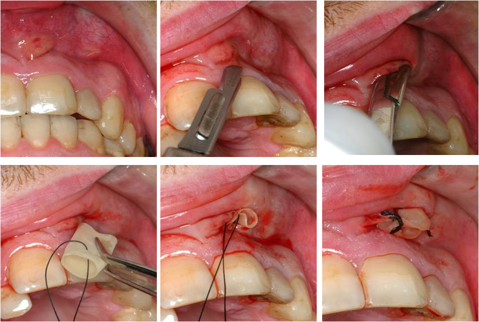 Incision et drainage d'un abces dentaire - procedure chirurgicale