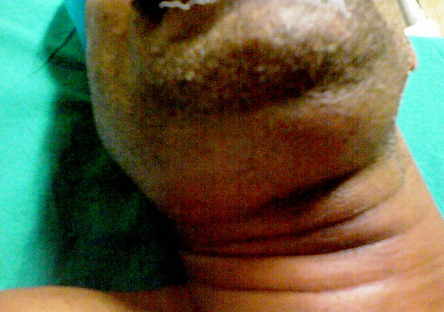 Angine de Ludwig - gonflement severe du plancher buccal et du cou, complication grave d'un abces dentaire
