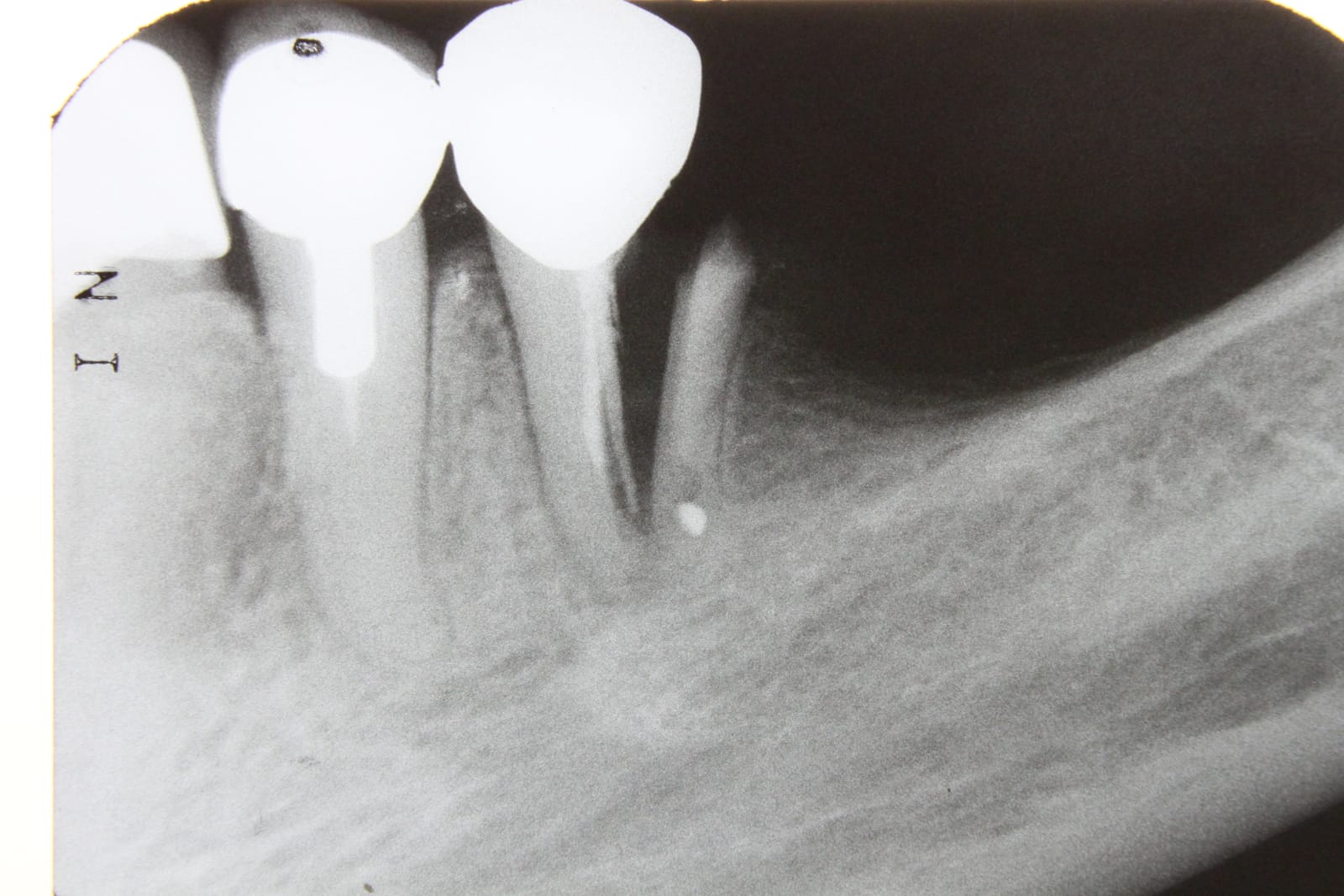 Radiographie dentaire montrant une fracture et les structures internes de la dent