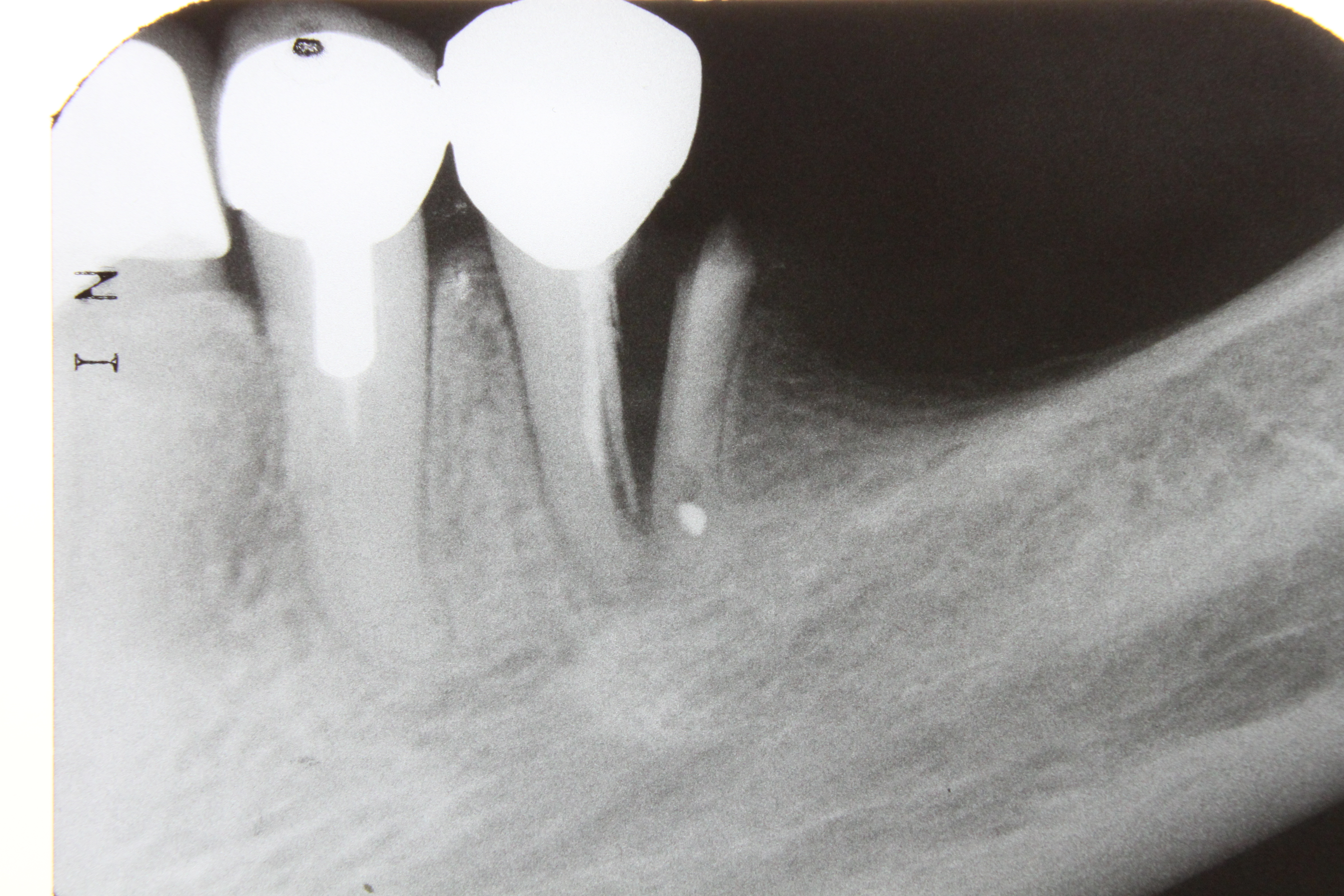 Radiographie dentaire montrant une fracture et les structures internes de la dent