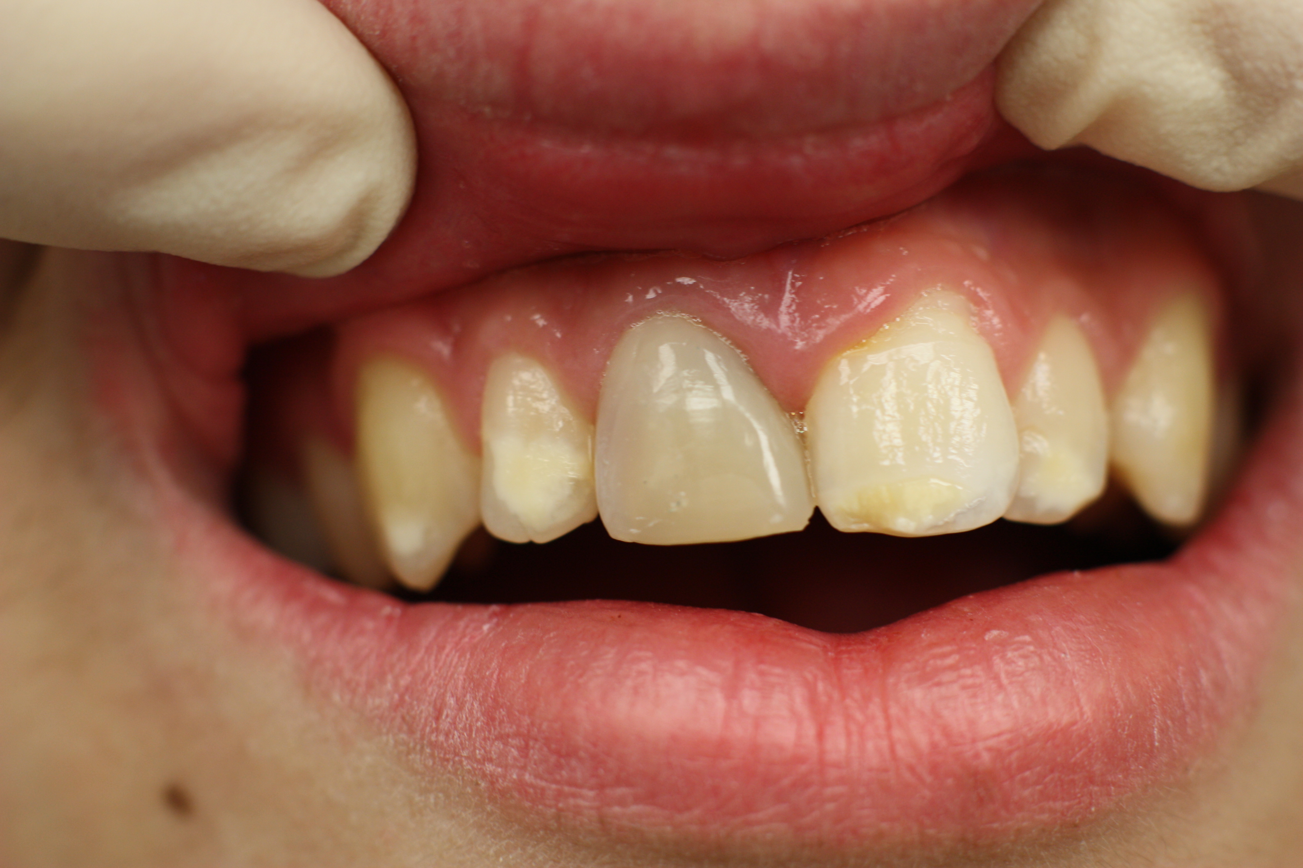 Traumatisme sur une incisive superieure - etapes de reparation par le dentiste