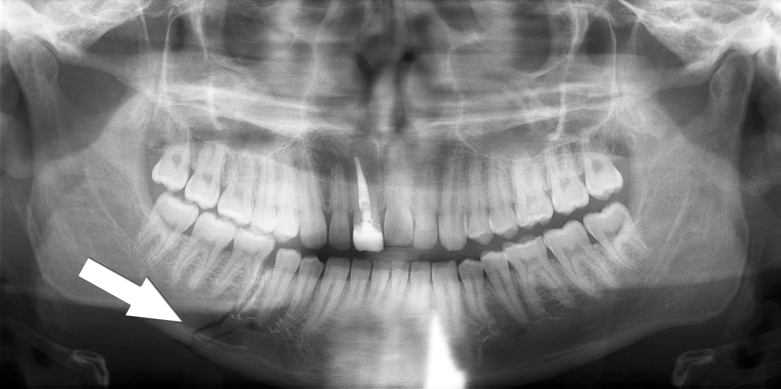 Radiographie d'une fracture mandibulaire - traumatisme facial grave