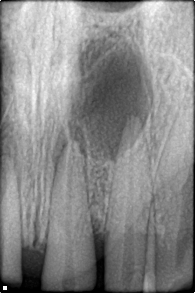 Radiographie periapicale montrant une lesion au bout de la racine apres un traumatisme