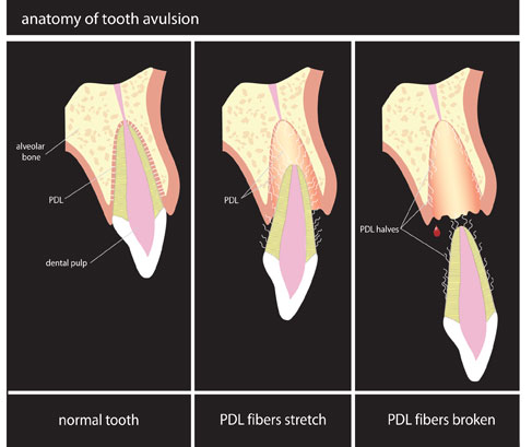 Dent expulsee (avulsion dentaire) - la dent est completement sortie de l'alveole