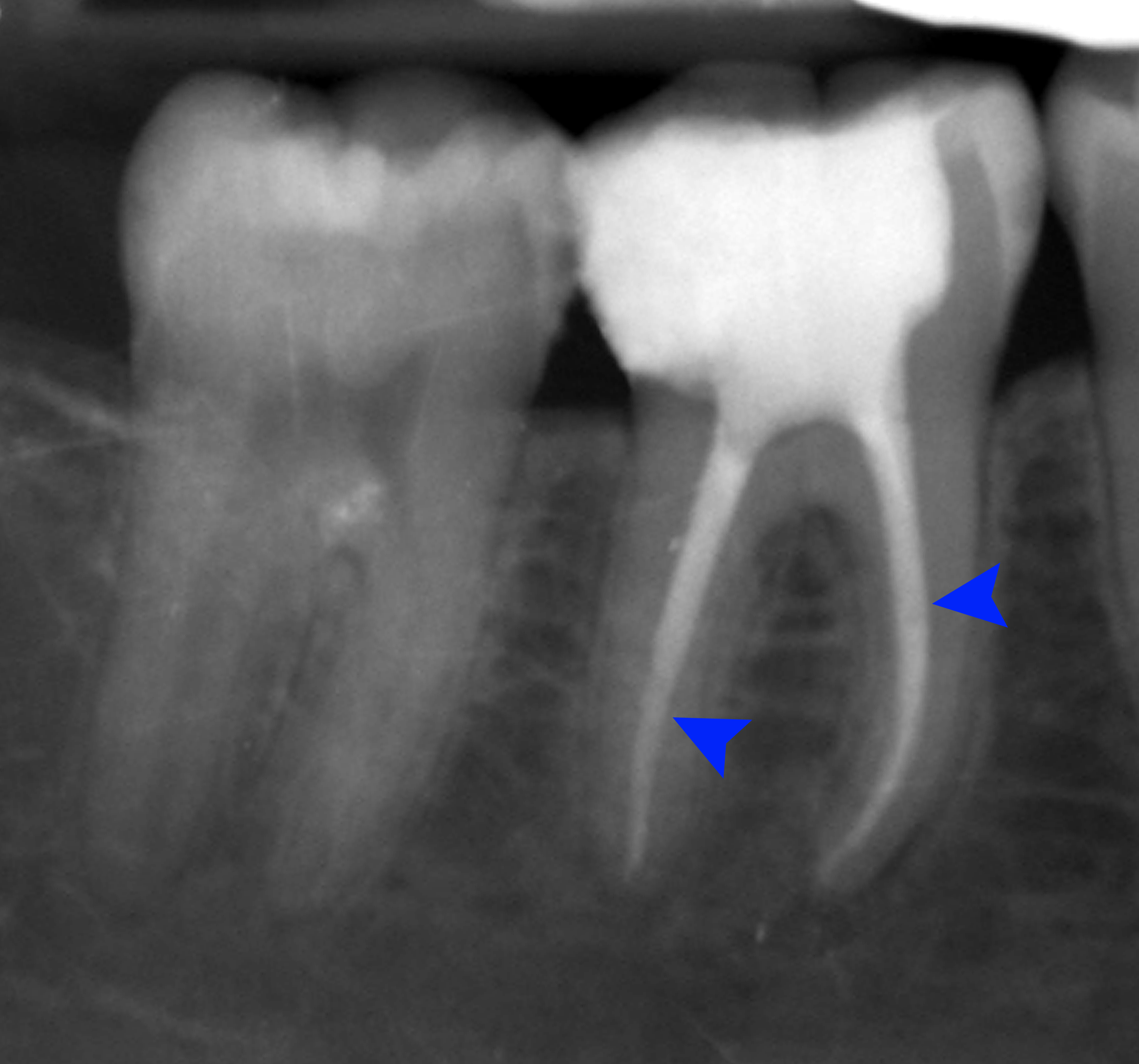 Traitement de canal (endodontie) - le traitement definitif de la pulpite irreversible