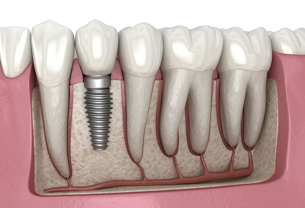 Illustration d'un implant dentaire et de sa structure